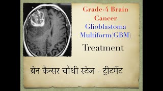 Question amp Answer5 Treatment of Brain Cancer Glioblastoma Multiform [upl. by Norel366]