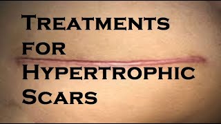 Treatments for Hypertrophic Scars [upl. by Lihcox]