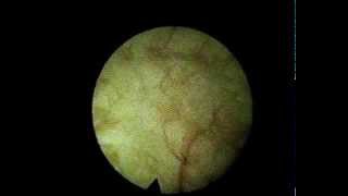 Cystitis cystica focal inflammation of the bladder Intertitial cystitis [upl. by Anaujal]