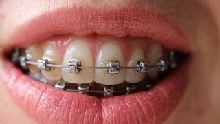 Braces time lapse  16 months [upl. by Liva544]