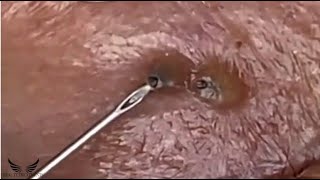 Severe Eye Blackhead Removal  Acne Cystic Treatment Spa  Pimple Popping Elderly Acne Remove  056 [upl. by Sari518]