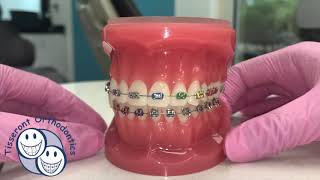 Elastics in Orthodontics  Class 3 [upl. by Randell]