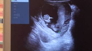 Pregnant with baby  11 weeks 1 day ultrasound [upl. by Matthieu]