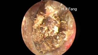 Another Difficult Earwax Cleaning另外一个困难的耳垢清理20230829 [upl. by Oibaf]