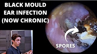 Black Mould Infection Is Now Chronic Otomycosis [upl. by Essyle287]