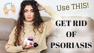 HOW TO GET RID OF PSORIASIS SERIOUSLY [upl. by Eiahpets]