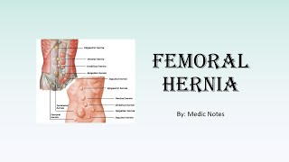 Femoral hernia  anatomy clinical features differential diagnosis investigation management [upl. by Gebler]