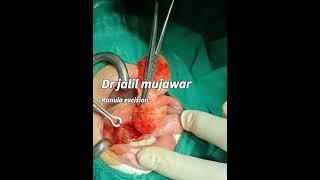 ranula  sublingual mucous cyst excision dr jalil mujawar [upl. by Irrej995]