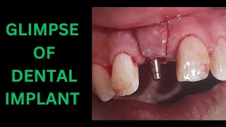 DENTAL IMPLANT CLIP OdontologyInnbyDrMuhammadAhmad [upl. by Storm]