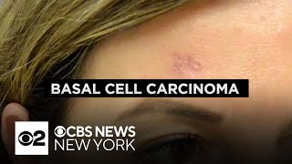 Dermatologist explains the dangers of basal cell carcinoma what to look out for [upl. by Yadroc]