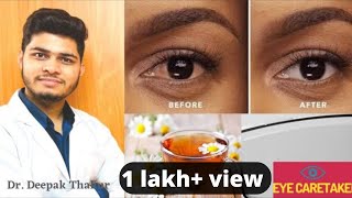 आँखों के पीले पन से छुटकारा पाए । how to cure yellow eye [upl. by Yltneb]