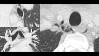 Traumatic pneumomediastinum  CT findings and basic diagnostic approach [upl. by Eselrahc427]