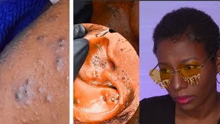 Best Blackhead Removal  Pimple Popping Reaction [upl. by Imerej]