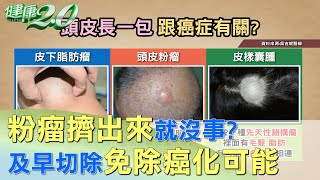 粉瘤擠出來就沒事？ 及早切除免除癌化可能 健康20 [upl. by Kellyann]