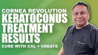 Keratoconus Treatment Results with CREATE Protocol and Crosslinking with Dr Motwani [upl. by Narih]