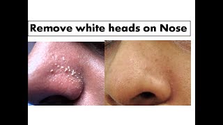 Turmeric to remove White heads on Nose Starnaturalbeauties [upl. by Rockey]