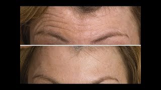 Face Exercise to Lift amp Tighten Your Forehead  FACEROBICS® [upl. by Stevens]