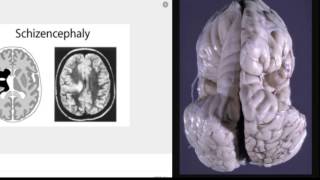 Schizencephaly presentation [upl. by Cline]