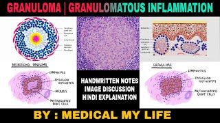 GRANULOMA  GRANULOMATOUS INFLAMMATION  Types Of Chronic Inflammation [upl. by Nytsirk]