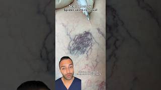 Removing Spider Veins With Sclerotherapy Treatments  Dr Somji Explains [upl. by Harutak]