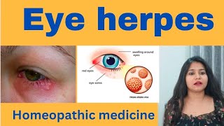 Eye herpes treatment  Eye herpes symptoms causes amp homeopathic medicine in hindi [upl. by Brnaby579]