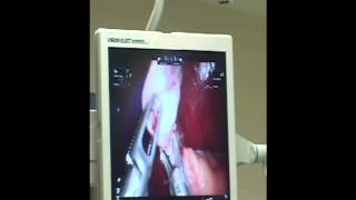 Thuy Nga Show  Dr Huy Nguyen in San Jose and Single site Robotic Laparoscopic Cholecystectomy [upl. by Calderon]