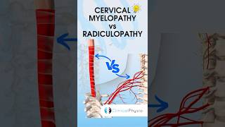 Cervical Radiculopathy vs Myelopathy physiotherapy physicaltherapy medical [upl. by Liggett]