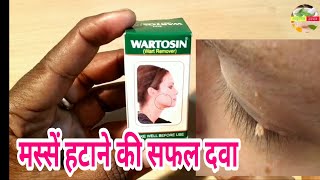 Wrtosin wart remover अपने मस्सों को हटाए हमेशा के लिए। [upl. by Bust]