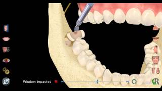 Impacted Wisdom Tooth Extraction [upl. by Weatherby]