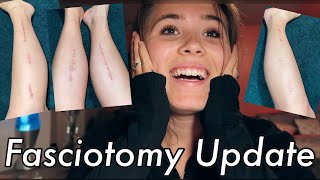 Fasciotomy Recovery  Post Surgery Update from Chronic Exertional Compartment Syndrome [upl. by Kho572]