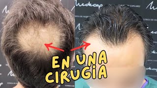 👨‍🦲➡️👨 ¡Espectacular Trasplante Capilar Frontal y Coronilla en una Cirugía Antes y Después 🌟 [upl. by Hatty58]