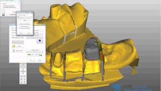 passerelle 3shape exocad telescope [upl. by Bonnell522]