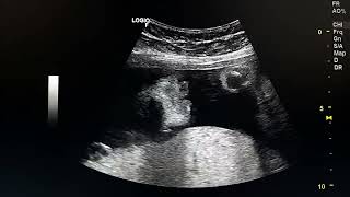 ultrasound case  fetus with cleft lipHPEgastroschisislarge echogenic kidneys [upl. by Charity838]