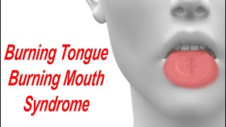 Burning Tongue and Burning Mouth Syndrome Causes and Treatment [upl. by Urial963]