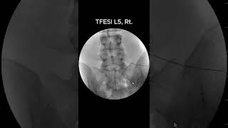 How to Accurately Perform L5 Transforaminal Epidural Steroid Injection TFESI 1 [upl. by Ariel]