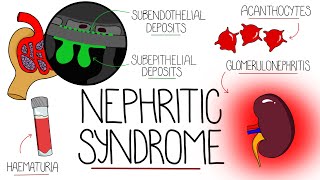 Understanding Nephritic Syndrome With Pathology Made Easy [upl. by Aihsenyt]