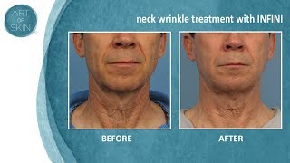 Neck wrinkle treatment with radiofrequency microneedling [upl. by Eisele]