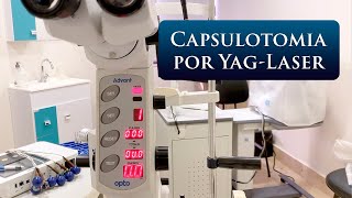 CAPSULOTOMIA POR YAGLASER [upl. by Kensell]