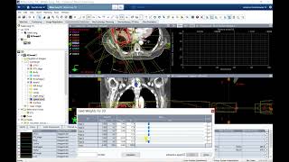 Week 1  3D vs IMRT Lung [upl. by Matta]