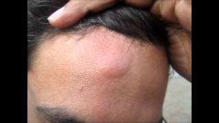 Head Injury Bump Home Treatment [upl. by Jacklin]