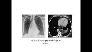 mediastinal diseases [upl. by Alverta]