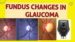 OPTIC DISC CHANGES IN GLAUCOMA [upl. by Georgeanne]