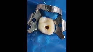 Access Cavity Preparation of Maxillary First Molar [upl. by Orozco218]