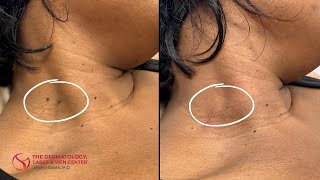 Skin Tag Removal  Dr Shalini Gupta [upl. by Salta]