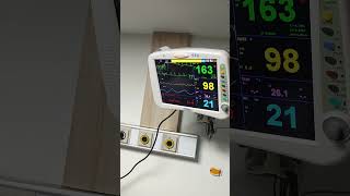 DefibrillationCardioversion in SupraVenticular tachycardia [upl. by Hiett]