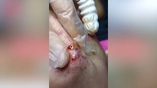 sebaceous filaments removal  ACNE REMOVAL [upl. by Meekah55]