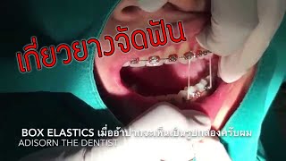 Ep14 การเกี่ยวยางอีลาสติกแบบ Posterior Box Elastics [upl. by Shaddock100]