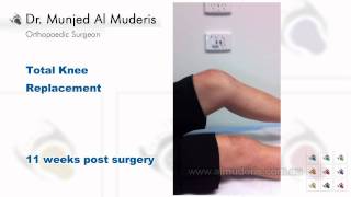 Total Knee Replacement  11 weeks post surgery [upl. by Atsejam]