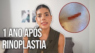 1 ANO APÓS RINOPLASTIA QUELÓIDE [upl. by Larine]