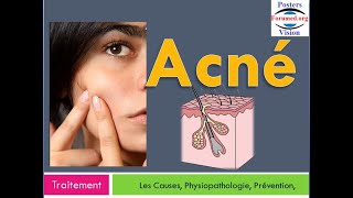 Quel Meilleur Traitement Pour l’Acné sévère du visage Méthode Laser Hormonale Naturel Antibiotique [upl. by Trimmer]